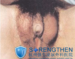 现代专家:治疗阴茎短小有招