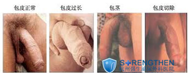 什么是包皮过长?什么是包茎?