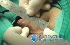 导致阴茎过小的原因是什么?