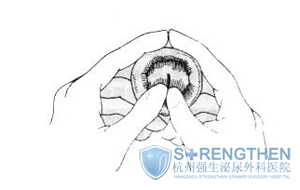 包皮水肿图片