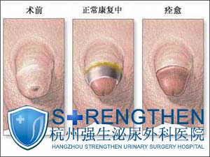 包皮包茎引起男性不育