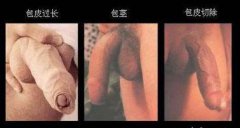 什么是包皮过长 包皮过长有什么害处